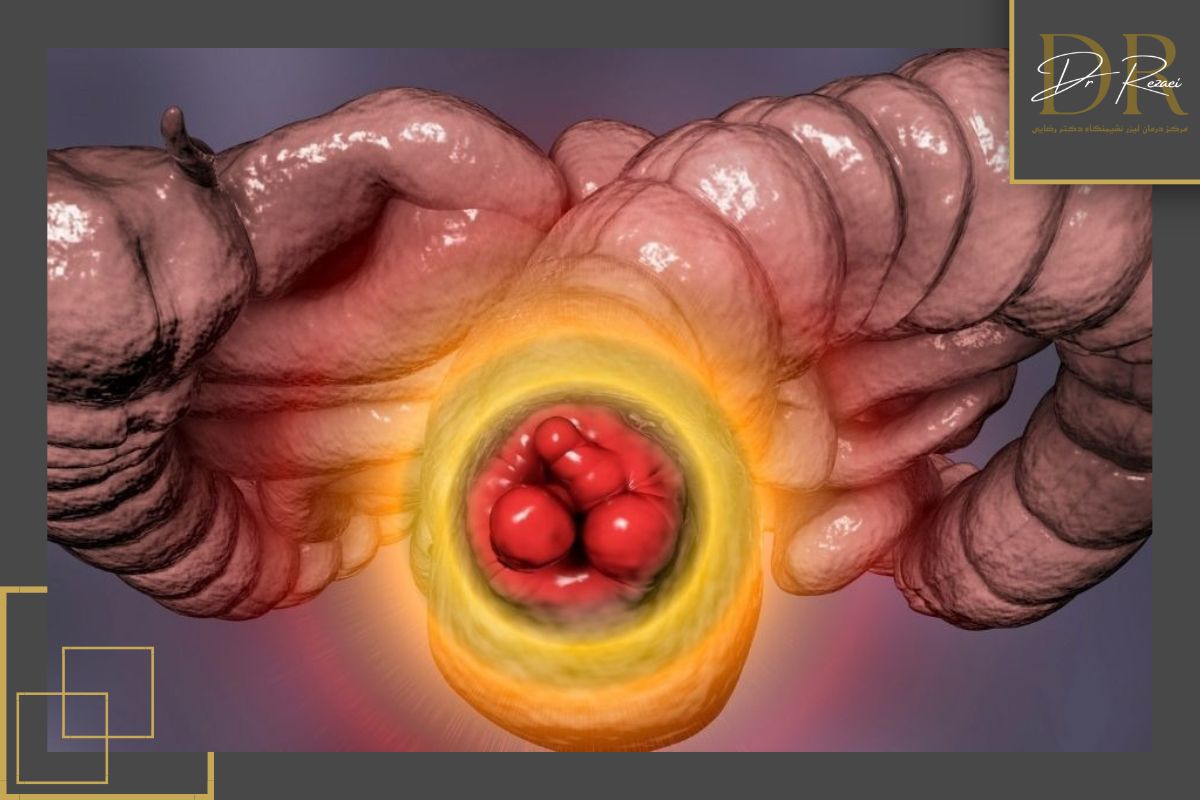 چرا نباید علائم بواسیر را نادیده بگیریم؟