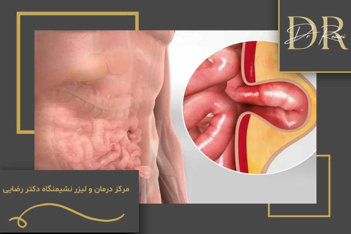 شیاف آنتی هموروئید؛ راهکاری موثر برای درمان بواسیر